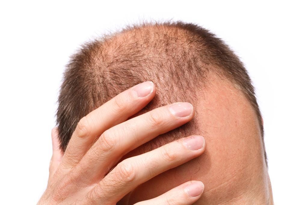 Hair transplant surgery becoming a popular solution for hair loss with rising global trends